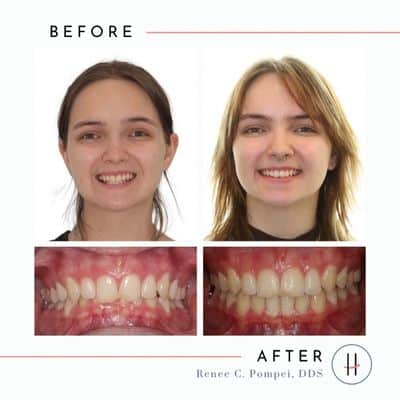 Let's Talk About Overbites - High Line Orthodontics