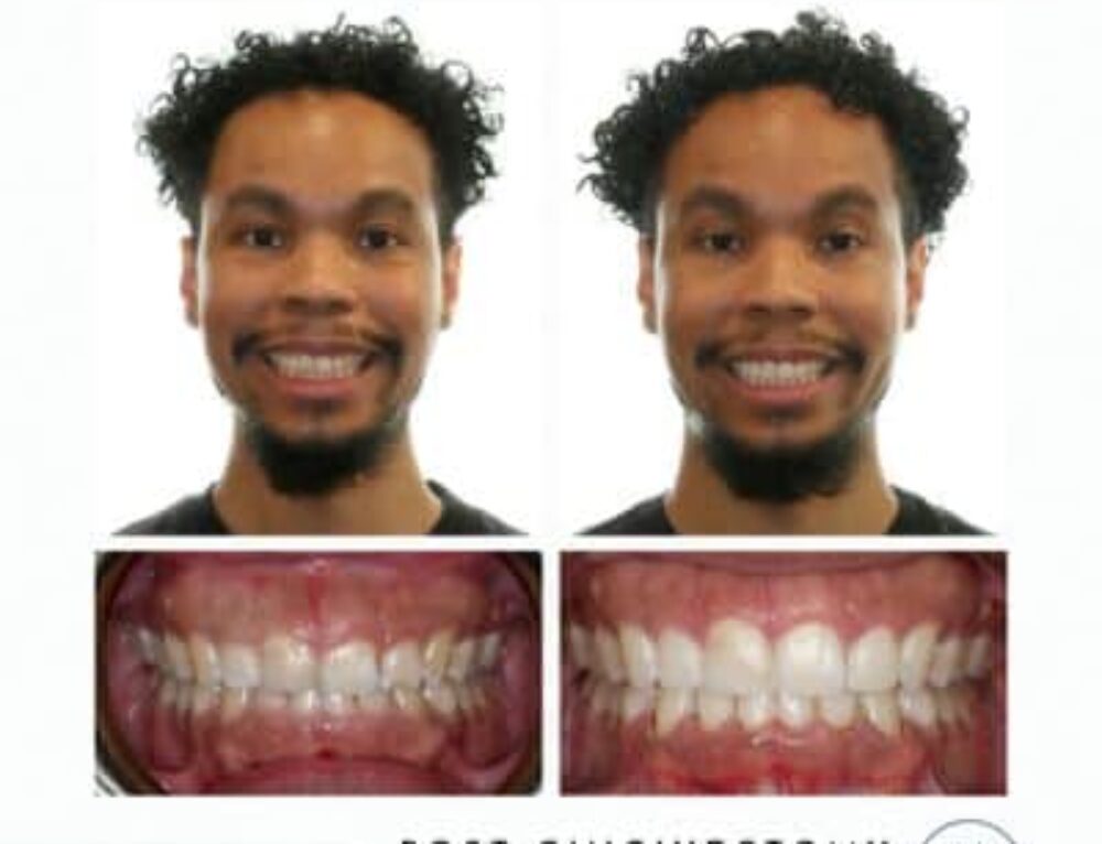 Interproximal Reduction (IPR) High Line Orthodontics